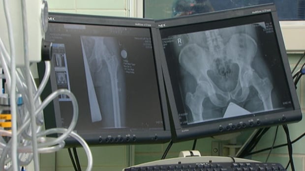 Islanders are waiting longer for hip, knee replacements than other Canadians, study says