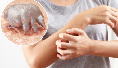 New Zealand families battle treatment-resistant scabies