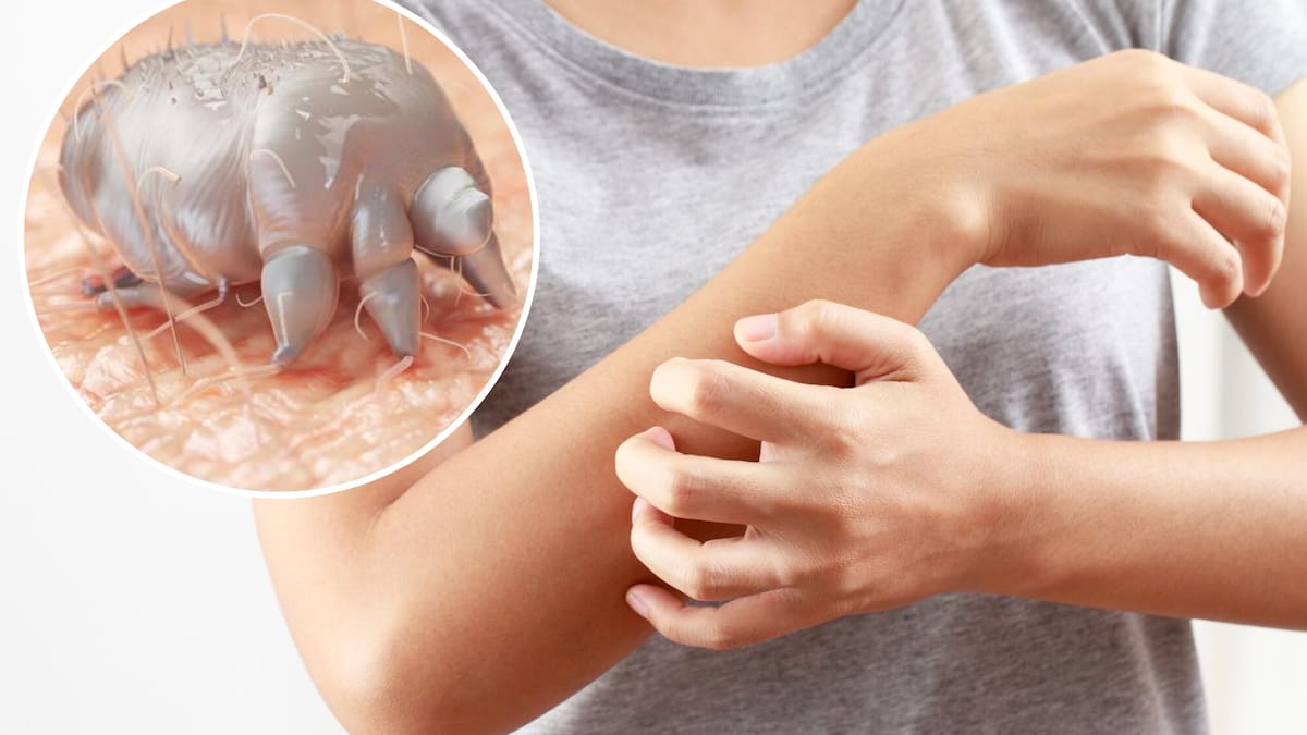 New Zealand families battle treatment-resistant scabies