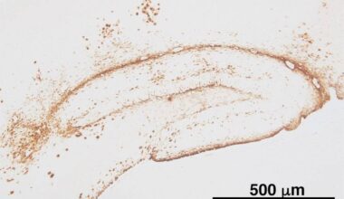 Japan scientists identify clusters of protein believed to trigger Alzheimer’s disease