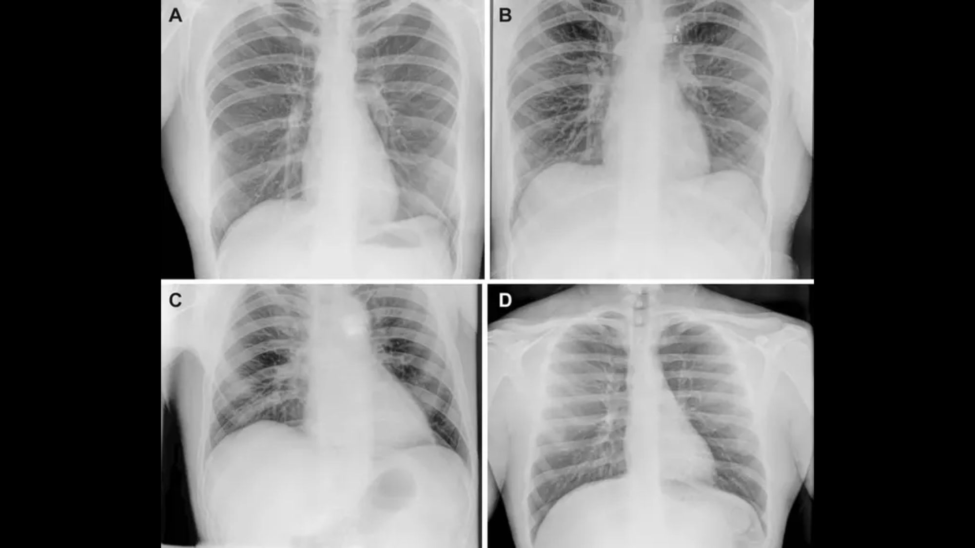 Four images of a chest X-ray.