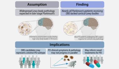 Study Finds Little to No Cortical Lewy Pathology in Living Parkinson’s Disease Patients Undergoing Deep Brain Stimulation