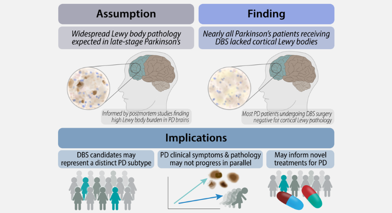 Study Finds Little to No Cortical Lewy Pathology in Living Parkinson’s Disease Patients Undergoing Deep Brain Stimulation