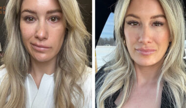 The Medical Minute: A Tick Bite Left Her Face Paralyzed - Specialized Treatment Helped Her Smile Again