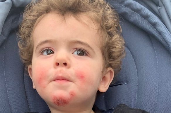Aaron Comer’s eczema “consumed him”.