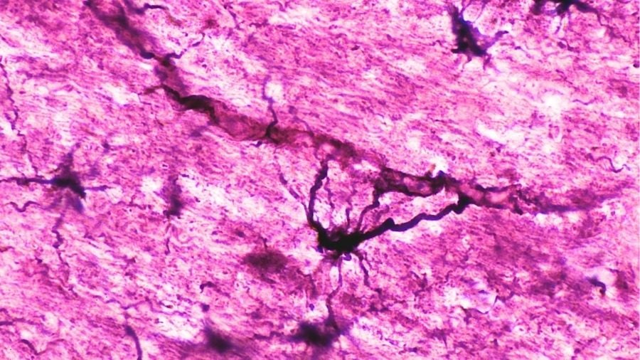 Two People With Severe Autoimmune Disease in Remission After Immune 'Reset' : ScienceAlert