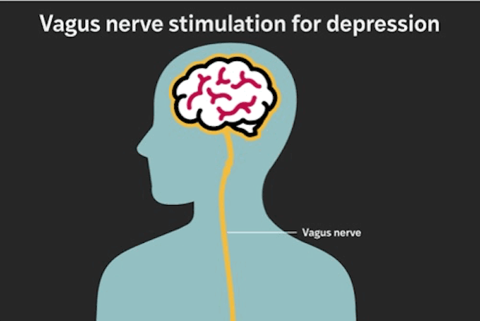 Illustration of a side profile of a human head and upper body showing vagus nerve stimulation for depression. A yellow line labeled 