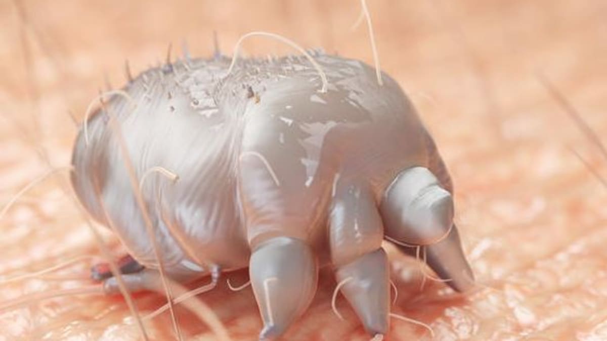 Scabies cases surge across North Island as school, health clinic issue warnings