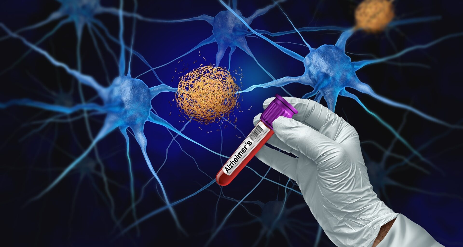 Study: Prognostic Value of Blood-Based P-Tau217 Levels for Progression to Cognitive Impairment. Image Credit: Lightspring / Shutterstock