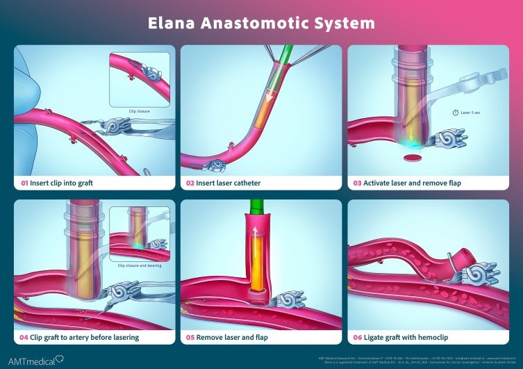 A breakthrough in coronary bypass surgery: AMT Medical’s SAFE-CAB results published in The Journal of Thoracic and Cardiovascular Surgery A breakthrough in coronary bypass surgery: AMT Medical’s SAFE-CAB results published in The Journal of Thoracic and Cardiovascular Surgery