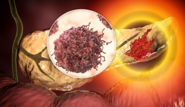 Red meat intake emerges as a potential pancreatic cancer risk factor