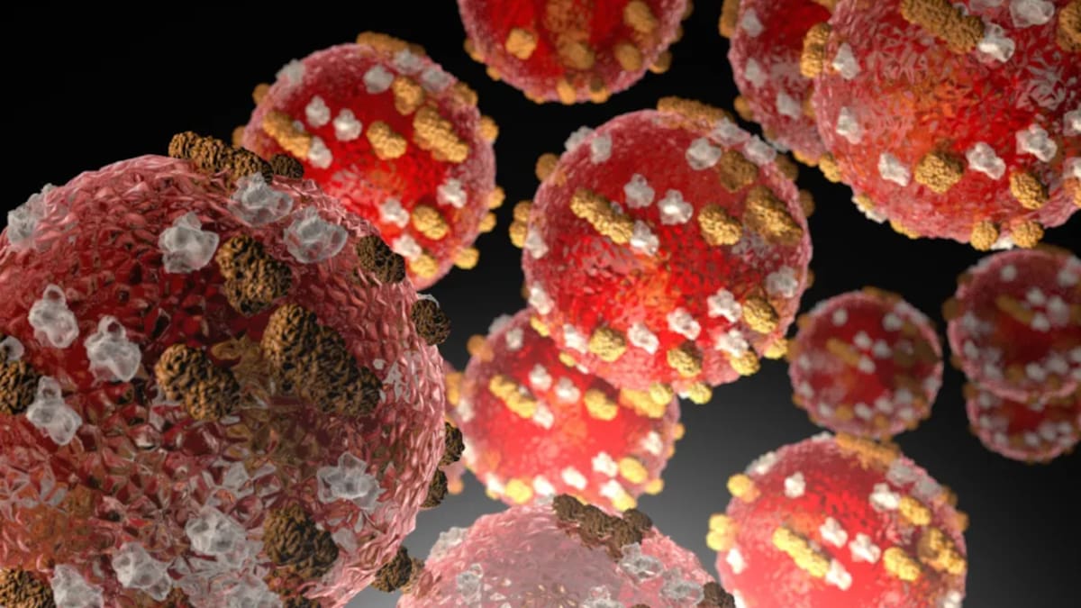 Palmerston North measles case prompts investigation into possible spread