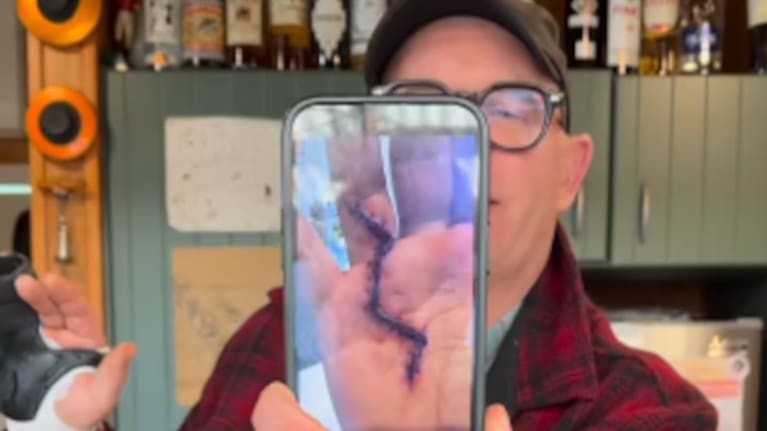 Hand surgery left Brown with a lightning scar, which he compares to Harry Potter's