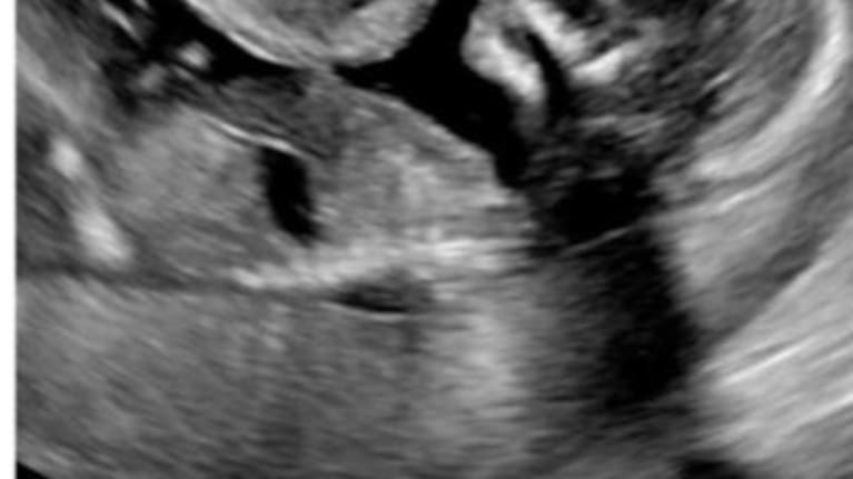 An ultrasound of Harrison. (Source: Givealittle)