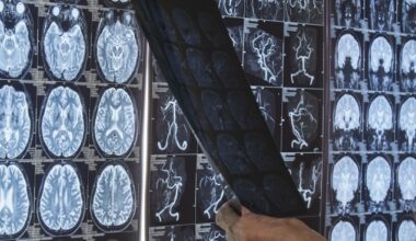 'Cool' new research aims to improve stroke patients' recovery