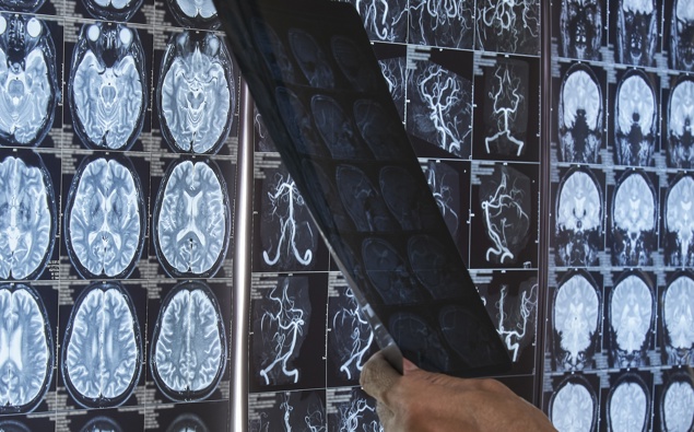 'Cool' new research aims to improve stroke patients' recovery