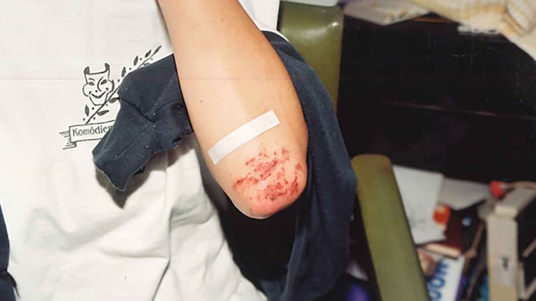 Cuts and grazes on Joanne Lees' arm following her ordeal.