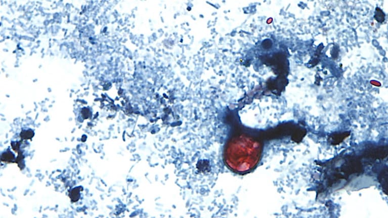 Cyclospora affects the bowels, often contracted through feces-contaminated products.
