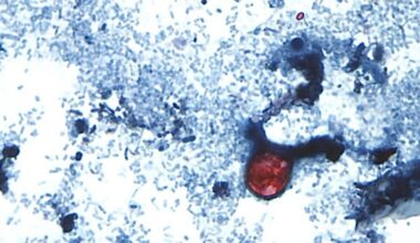 Diarrhoea-causing parasite: New US outbreak under investigation