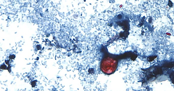 Diarrhoea-causing parasite: New US outbreak under investigation