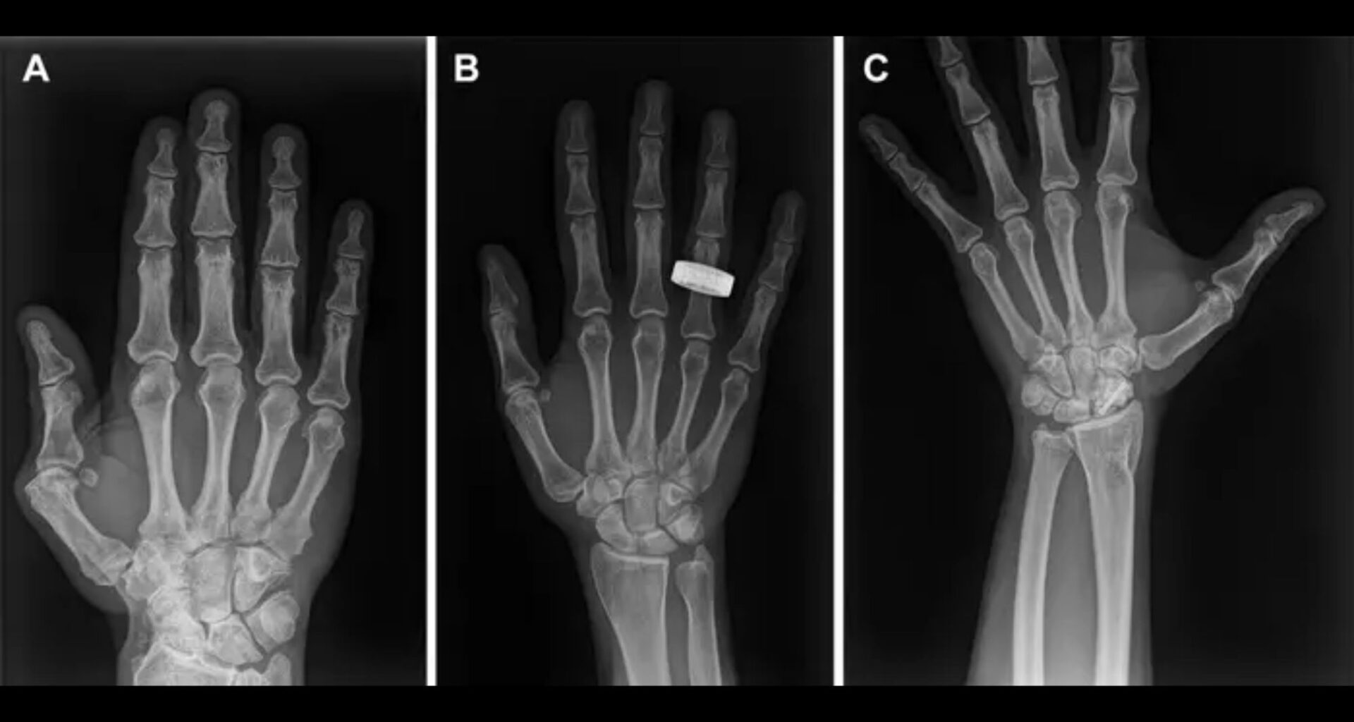 1st-ever X-rays in space offer hope for possible patients headed to the moon