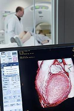 Atherosclerosis: Can AI help your doctor detect it?