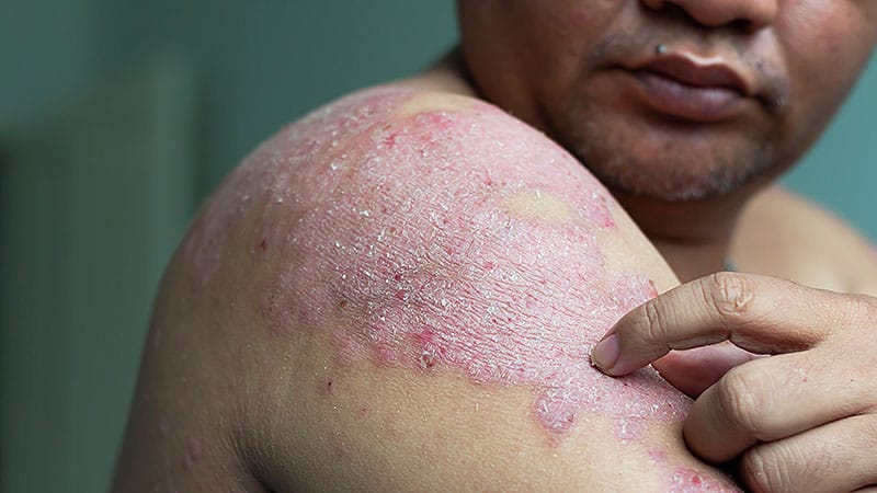 Skip the Stairs: The Elevator Approach to Psoriasis