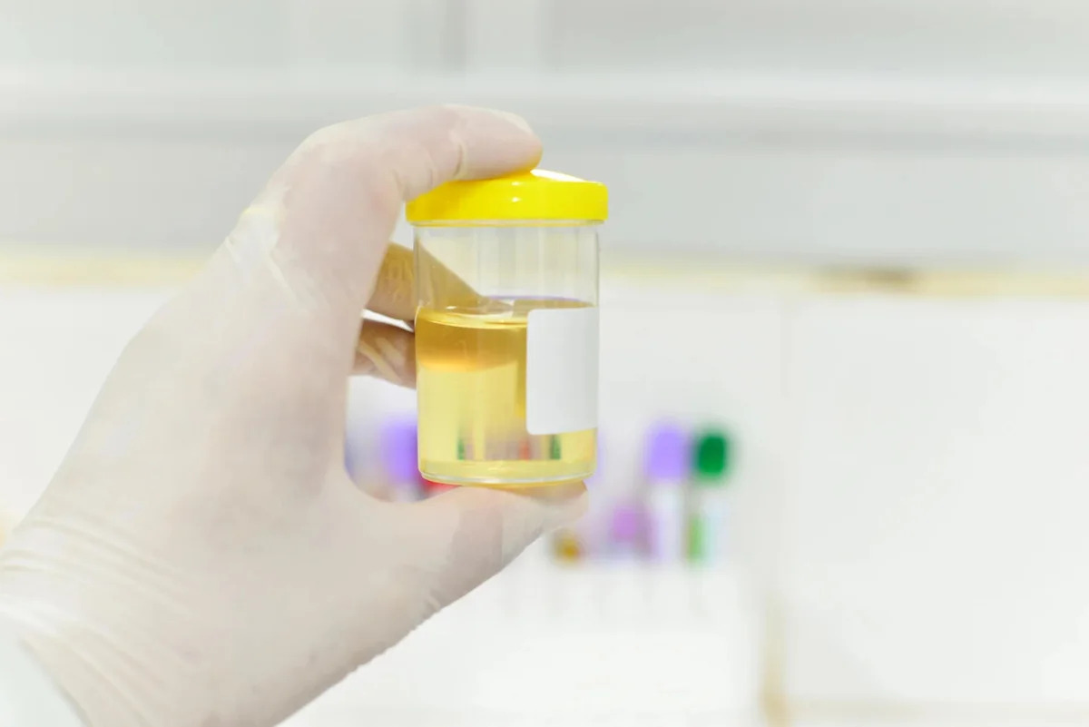 Urine biopsy offers a more accurate way to detect bladder, kidney and prostate cancers