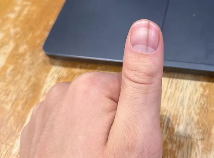 A thumb with a dark vertical line on the nail, a medical symptom doctors wish people wouldn't ignore.