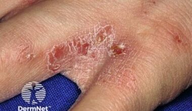 Ivermectin Mass Drug Administration Program Slashes Scabies Risk in the Pacific Islands