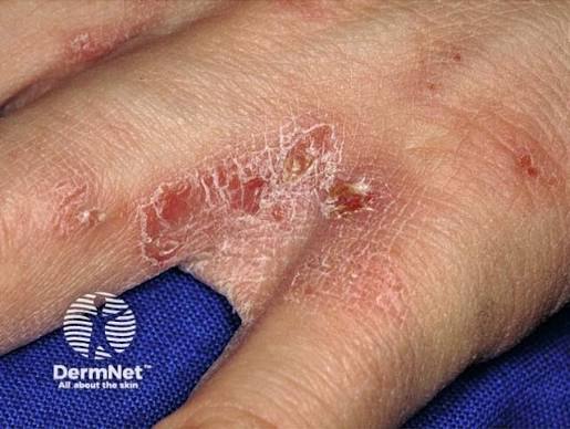 Ivermectin Mass Drug Administration Program Slashes Scabies Risk in the Pacific Islands
