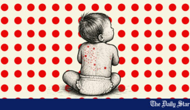 6 more die with suspected measles, combined toll reaches 816