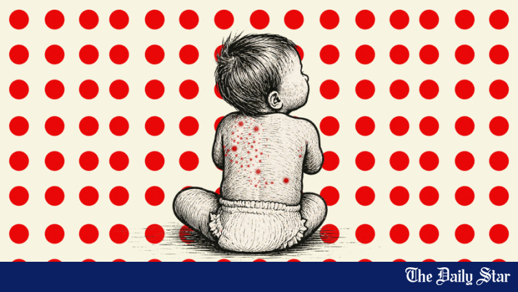 6 more die with suspected measles, combined toll reaches 816