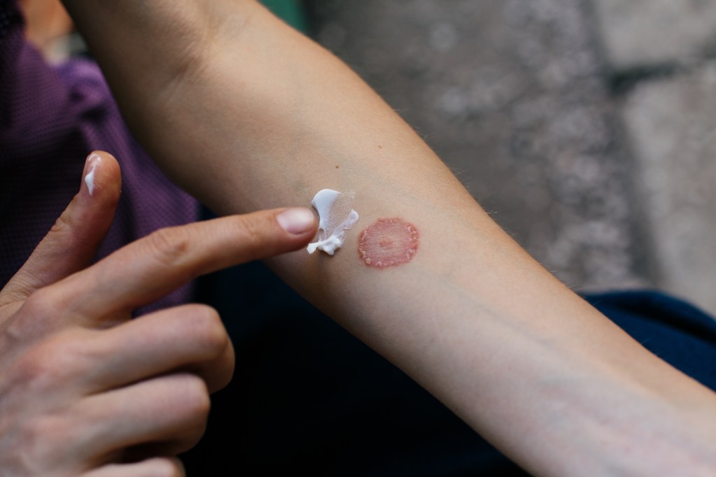 Applying cream to a ringworm infection on an arm.