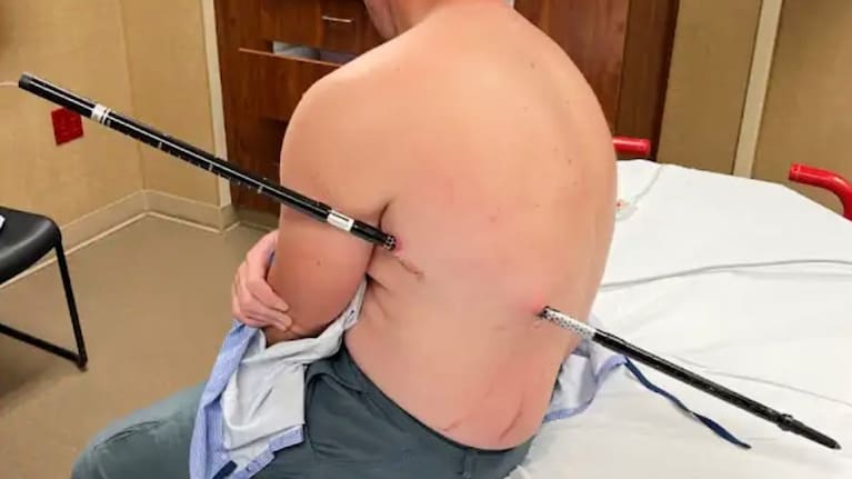 This photo provided by David Cifaldi shows Cifaldi while he was being treated Monday, July 20, 2026, at St. Vincent Regional Hospital in Billings, Mont.