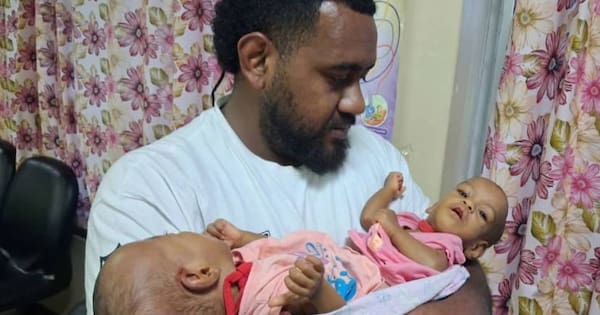 Saudi Arabia helps conjoined Fijian twins – other nations asked for $1m
