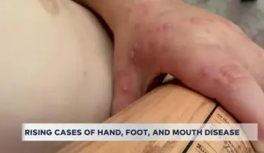 Hand, foot and mouth disease: What you need to know