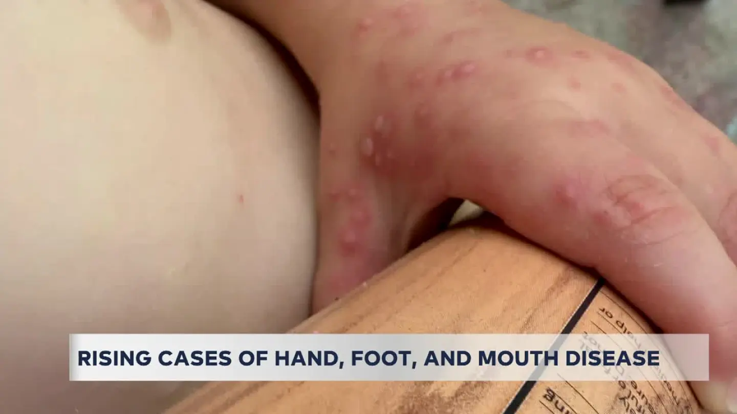 Hand, foot and mouth disease: What you need to know