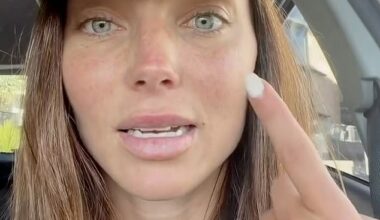 Australian model Tilly Smith, 32, has revealed she was diagnosed with a rare form of eye cancer, as she issues a dire warning to her followers about skin cancer checks