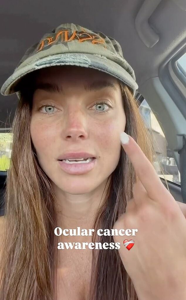 Australian model Tilly Smith, 32, has revealed she was diagnosed with a rare form of eye cancer, as she issues a dire warning to her followers about skin cancer checks