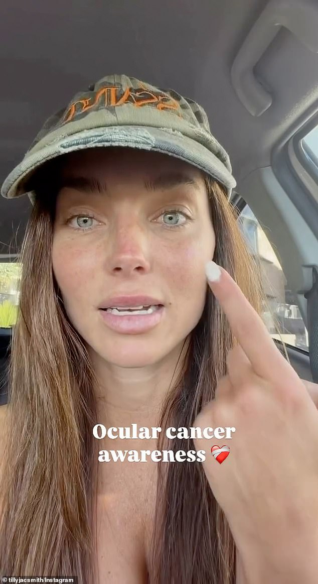 Australian model Tilly Smith, 32, has revealed she was diagnosed with a rare form of eye cancer, as she issues a dire warning to her followers about skin cancer checks