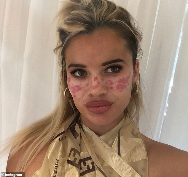 The 25-year-old was hospitalised with horrific facial injuries from a hack she copied from TikTok, her face scarred and disfigured after self-administering acupuncture and using lead-based ink to add black dots to her cheeks and nose
