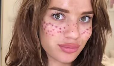Tilly Whitfield (pictured) tried her hand at tattooing her own face back in 2021  in an attempt to acquire trendy freckles