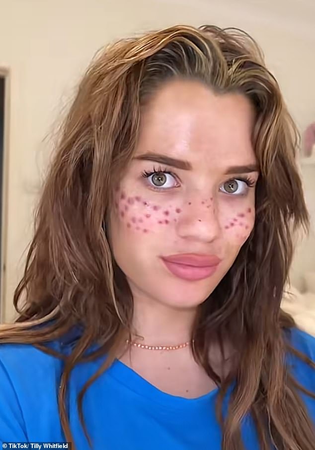 Tilly Whitfield (pictured) tried her hand at tattooing her own face back in 2021  in an attempt to acquire trendy freckles