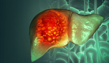 Microarray predicts liver cancer drug responses