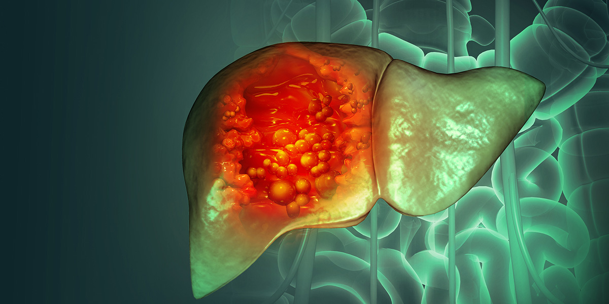 Microarray predicts liver cancer drug responses