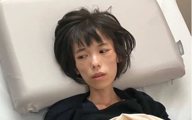 Runa weighed just 20 kilograms before her death. Her family allowed this image to be released because it says she is unrecognisable at this weight.
