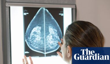 AI can detect heart disease in women using mammograms, study suggests | Women's health