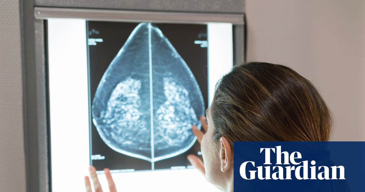 AI can detect heart disease in women using mammograms, study suggests | Women's health