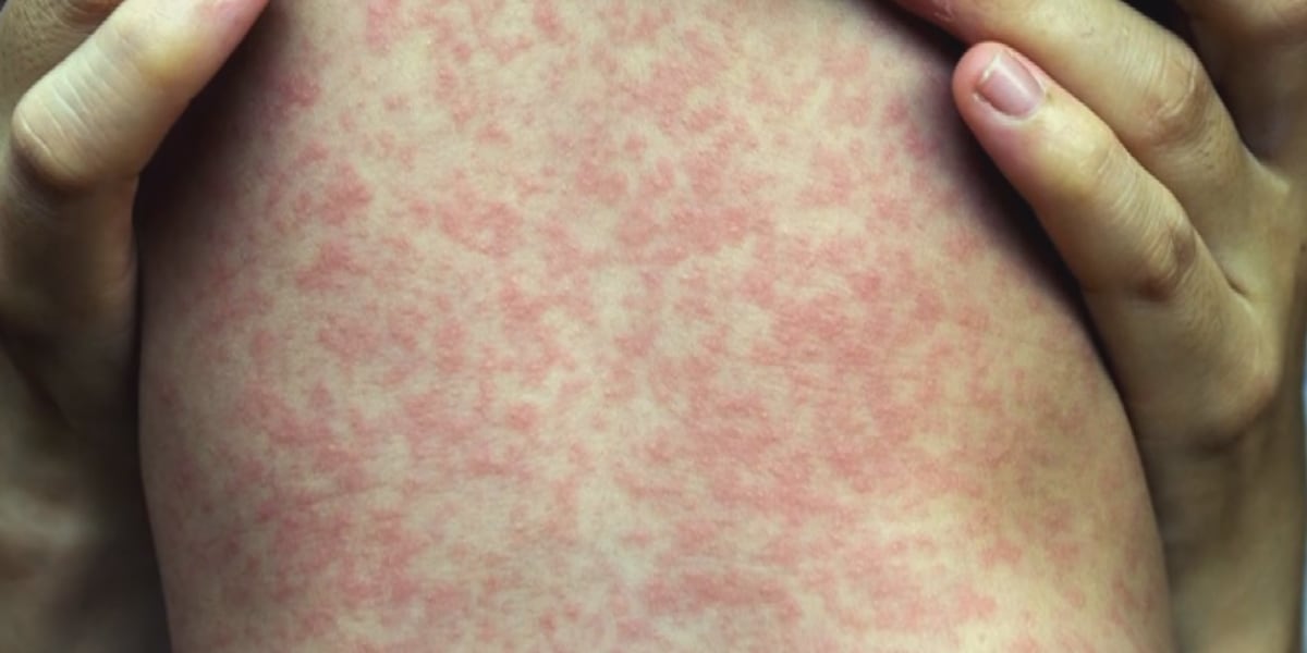 Outbreak of Measles confirmed in Kentucky; officials report hospitalizations